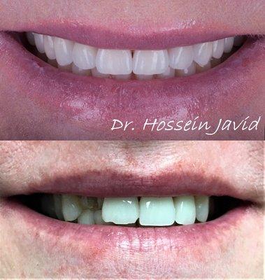 Full mouth Signature Smile Makeover