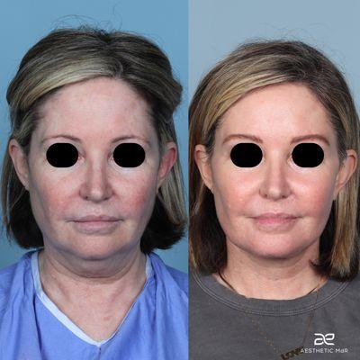 5mo. post-op, Composite Extended Deep Plan Facelift with fat grafting to the mid face, pre-jowl sulcus, temples and lips.