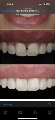 Before and after Invisalign and cosmetic bonding