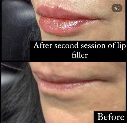 Results of natural heart lip filler technique