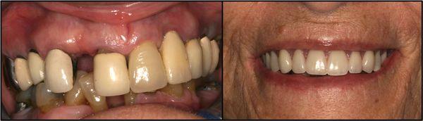 Replace failing teeth with implant supported dentures