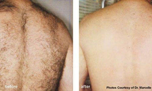 Pain free Laser Hair Removal