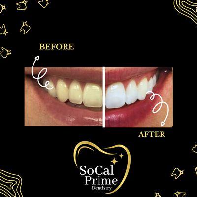 Transform your smile with our advanced teeth whitening treatment, revealing a brighter, confident you!