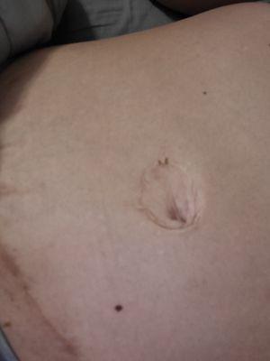 That's my belly button he had moved over for my tummy tuck