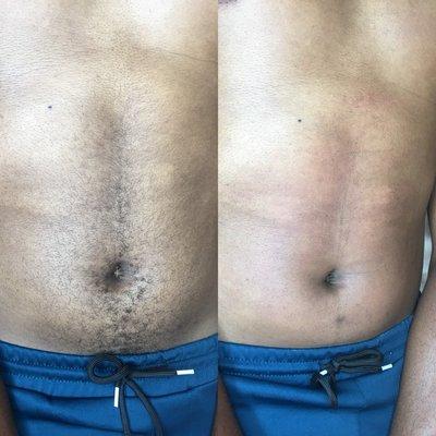 Male chest wax