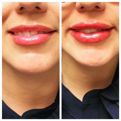 Before and after lip filler!