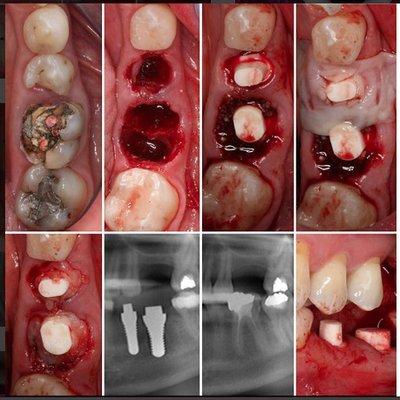 Patient wanted ceramic implants.She read online titanium implant alloys contain small traces of Nickel. Her Melissa test show nickel allergy