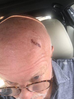 Was hit on the head from garage project. 
 Day 1.