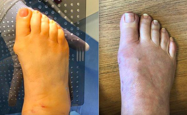 Minimally invasive bunion surgery (MICA bunionectomy)