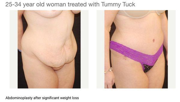 Tummy Tuck :)