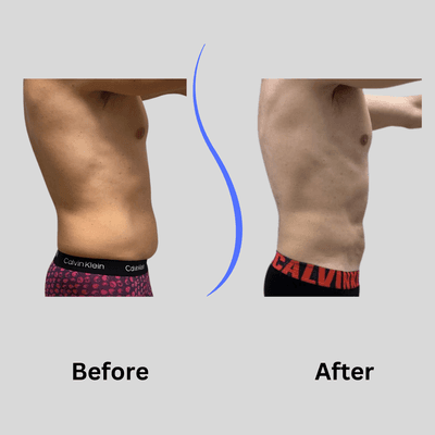 Male belly Funsculpting HD lipo