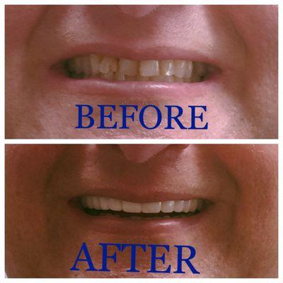 Patient was self conscious about his smile, now he has a Snap on Smile that he loves! Call us if you want to learn more about Snap on Smile!