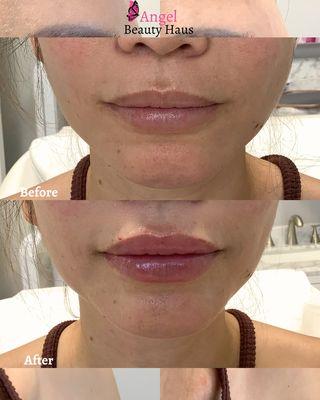 Before and after 1 syringe of Juvederm!!