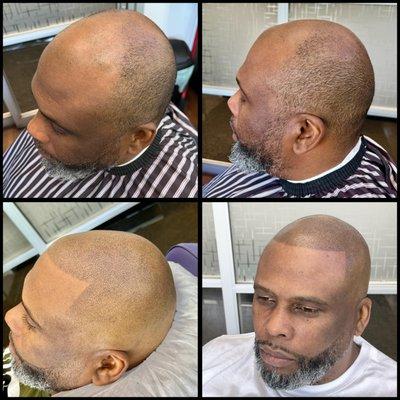 Scalp Micropigmentation