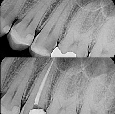 Before & After: Root canal on a pre-molar tooth