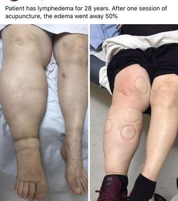 Treating lymphedema patient before and after one session