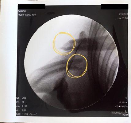 Does this fracture look like fun?? #agony