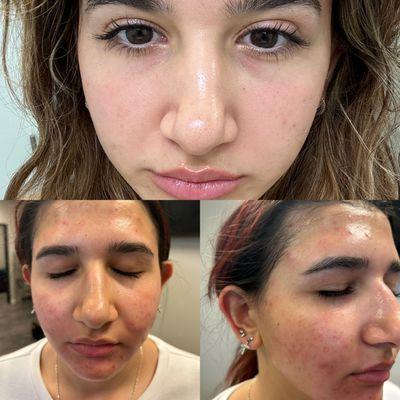 Acne treatment  after 2 Purfect peel