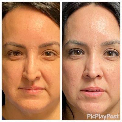 Rhinoplasty before and afters