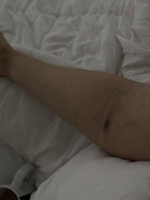 Separate occasion of bruising on IV site.