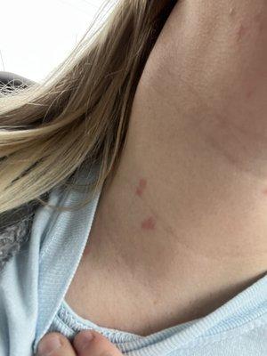 Bug bites