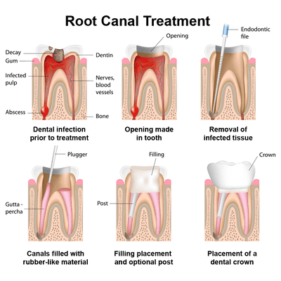 Root Canal Therapy - Steps and diagram representations