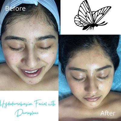 Hydrodermabrasion with Dermaplane Facial