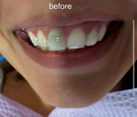 Front tooth discoloration several years after root canal treatment