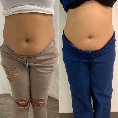 Non Invasive Lipo/ Cavitation Dear Body By Tiera