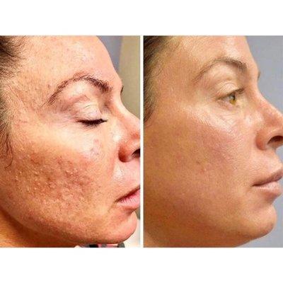 Microneedling Face