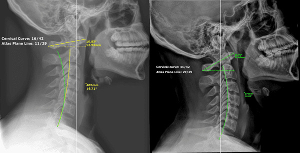 36 visit progress with a 25 degree cervical curve increase!