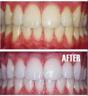 Get Our Whitening Special Now Until the End of Year For ONLY $150.00