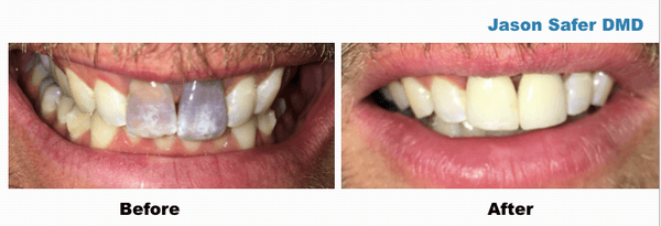 Crowns to fix front discolored teeth