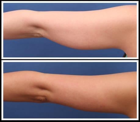 Procedure: Laser Lipo - Arms

Actual patient of Dr. Hannah Vargas