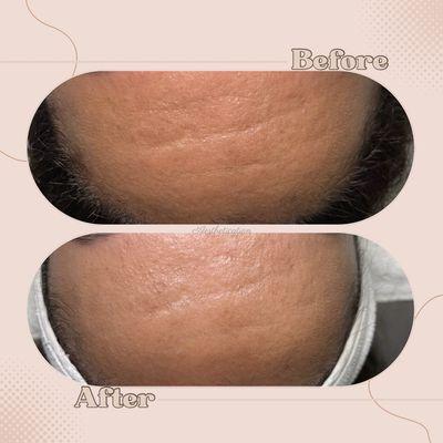 Collagen rejuvenation therapy, microcurrent, and DMK muscle banding combination treatments to achieve these results on our client.