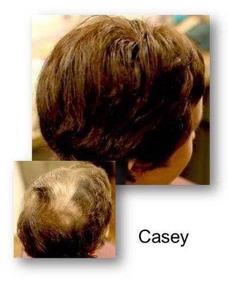 Casey had a disease that caused her hair to fall out.