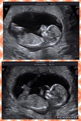 2d Ultrasound is just as fun. Gender Reveal