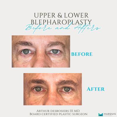 Upper & lower blepharoplasty