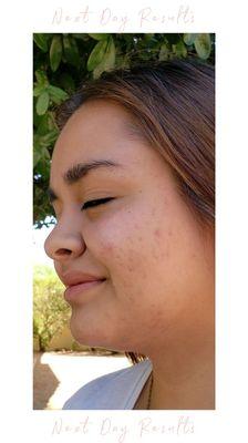 Next day results after Laser Acne Treatment