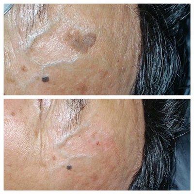 Instant results after the removal of a pigmented lesion using Sciton Contour TRL