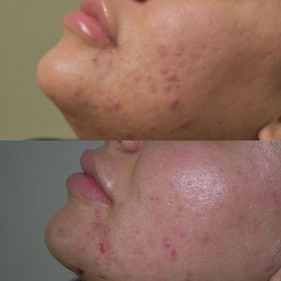 Microneedling with PRP