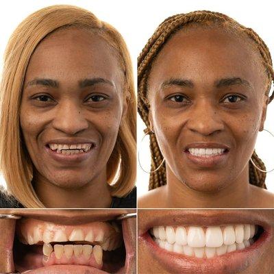 Beautiful before/after with Full Mouth Implants