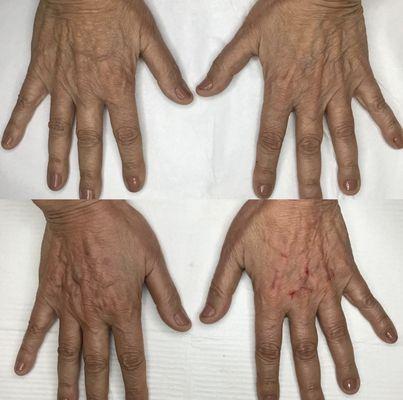 Filler for hands to decrease volume loss