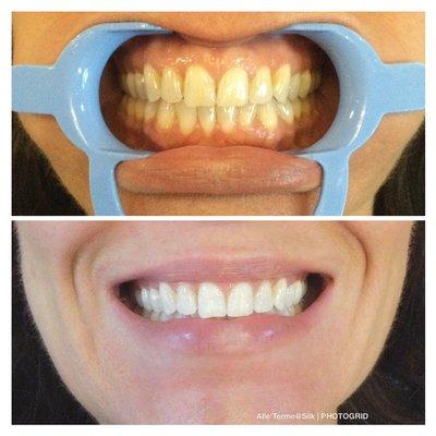 DaVinci teeth whitening... amazing results before you leave the spa!