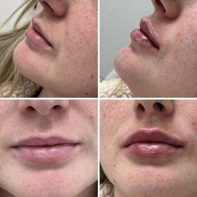 Lip enhancement