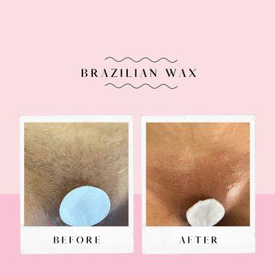 Brazilian Wax before and after. Stop shaving daily or very frequent. Come get waxed only 1x a month!