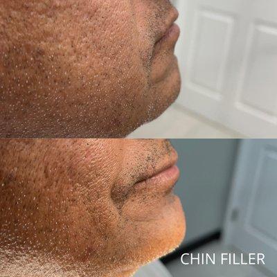 Chin filler