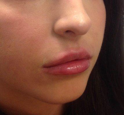 Natural lip filler results