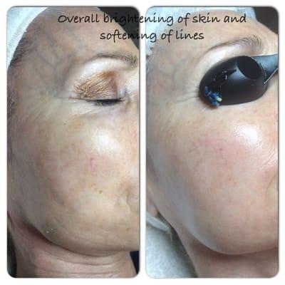 Before and after FSD microphoto facial therapy.