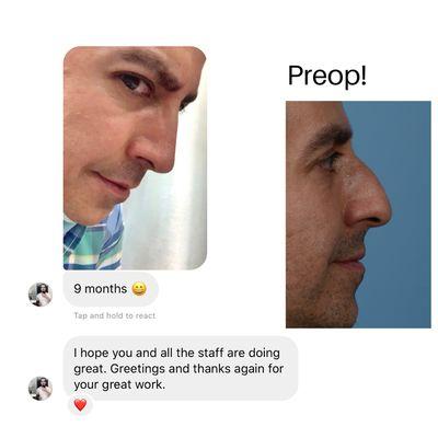 Patient selfie and testimonial, loving his new nose shape!